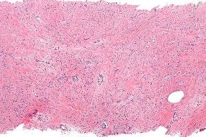 File:Mammary myofibroblastoma - intermed mag.jpg