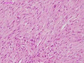 Medium power view (x 10) of core biopsy showing cellular stroma with an occasional mitotic figure