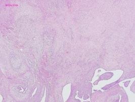 Macro of a malignant phyllodes tumour