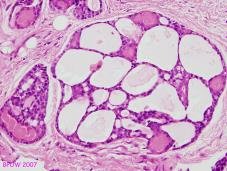 Adenoid cystic carcinoma of breast